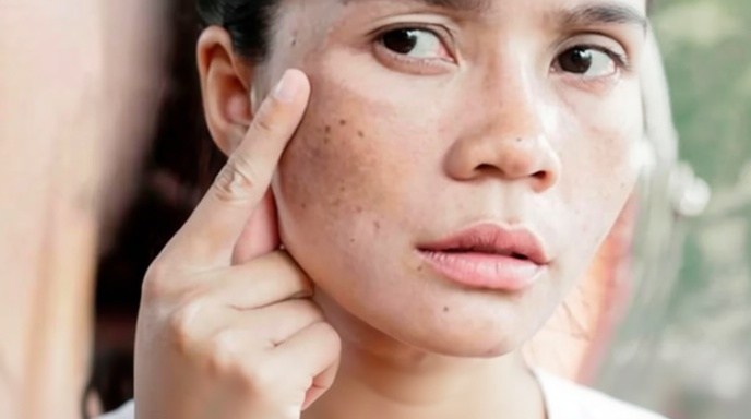 পিগমেন্টেশন দূর করতে প্রাকৃতিক উপাদানের ব্যবহার